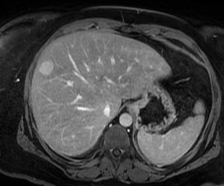 MRI
